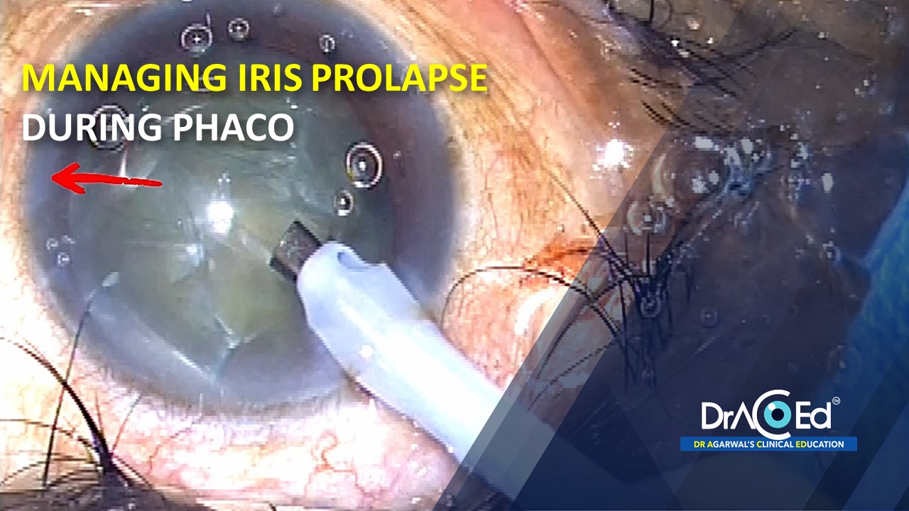 MANAGING IRIS PROLAPSE DURING PHACO